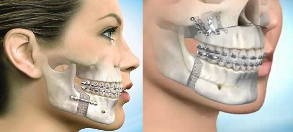 Ortodontia associada à cirurgia ortognática